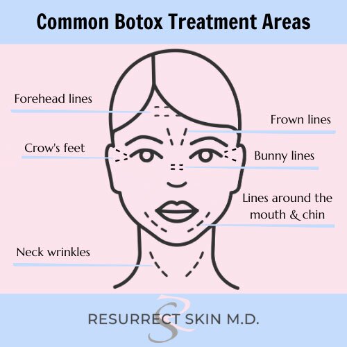 botox treatment